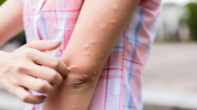Ni avispas ni mosquitos: estos son los animales con las picaduras más peligrosas del verano