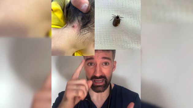 David Callejo, médico y divulgador científico: “No la líes, las garrapatas no se quitan ni con alcohol ni quemándolas. Pueden vomitar y pegarte infecciones” 