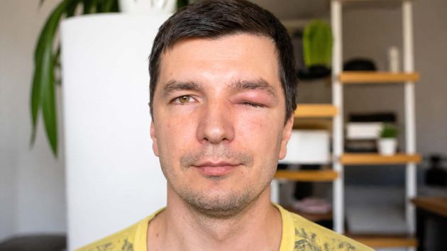 La Seguridad Social le deniega la incapacidad permanente tras perder un ojo y agotar los 545 de incapacidad temporal y la justicia obliga al INSS a darle la razón