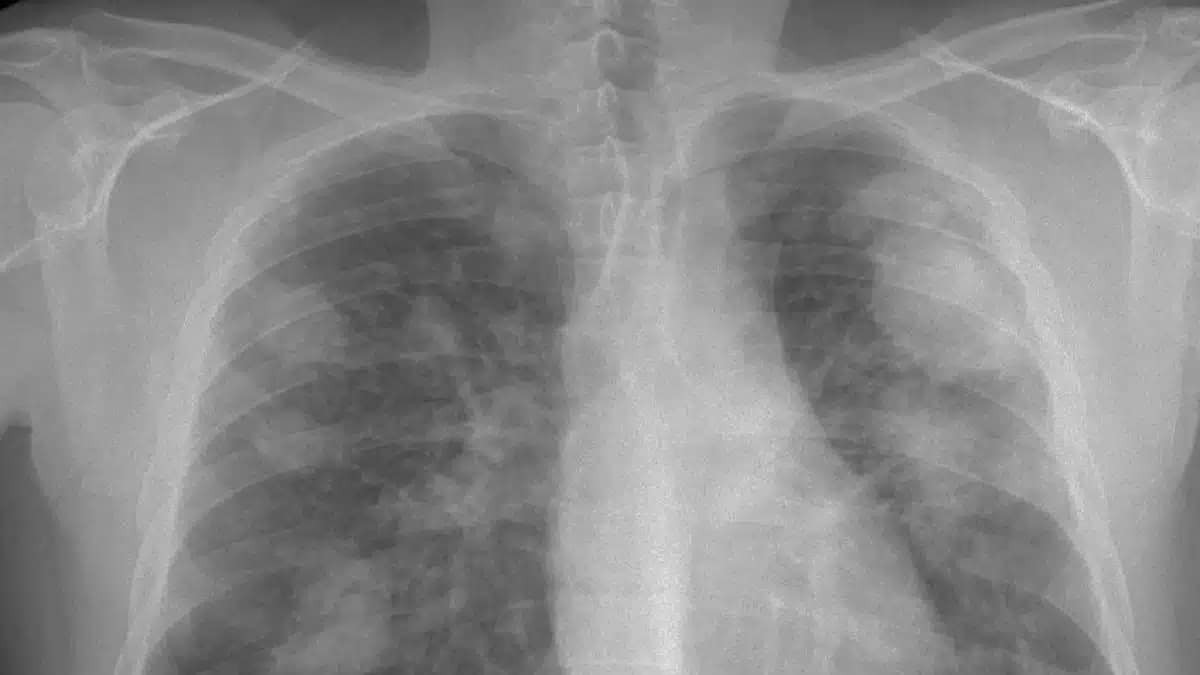 Preocupación por los 355 casos de silicosis en España: se sospecha de las encimeras de piedra artificial